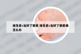 维生素c治好了银屑 维生素c治好了银屑病怎么办