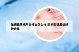 脓疱银屑病不治疗会怎么样 脓疱型银屑病好转迹象