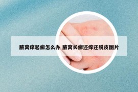 腋窝痒起癣怎么办 腋窝长癣还痒还脱皮图片