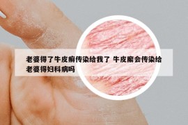 老婆得了牛皮癣传染给我了 牛皮廨会传染给老婆得妇科病吗