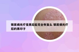 银屑病光疗变黑后能完全恢复么 银屑病光疗后的黑印子