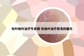 松叶柏叶治疗牛皮癣 松柏叶治疗脱发的偏方