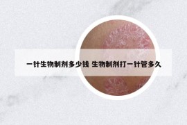 一针生物制剂多少钱 生物制剂打一针管多久