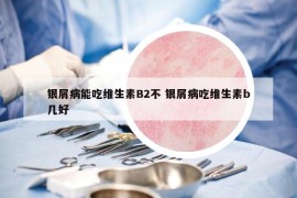 银屑病能吃维生素B2不 银屑病吃维生素b几好