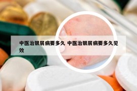 中医治银屑病要多久 中医治银屑病要多久见效