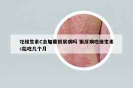 吃维生素C会加重银屑病吗 银屑病吃维生素c能吃几个月