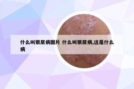 什么叫银屑病图片 什么叫银屑病,这是什么病