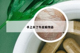 手上长了牛皮癣传染