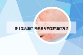 体廯怎么治疗 体癣最好的怎样治疗方法