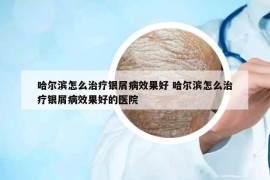 哈尔滨怎么治疗银屑病效果好 哈尔滨怎么治疗银屑病效果好的医院