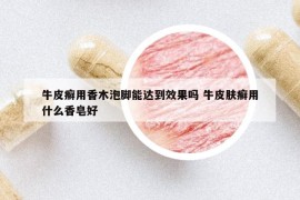 牛皮癣用香木泡脚能达到效果吗 牛皮肤癣用什么香皂好