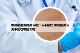 银屑病引走的关节病什么不能吃 银屑病关节炎不能吃哪些食物