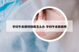 孕妇牛皮癣特别痒怎么办 孕妇牛皮肤癣吧