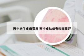 西宁治牛皮癣费用 西宁皮肤病专科哪里好