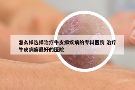 怎么样选择治疗牛皮癣疾病的专科医院 治疗牛皮病癣最好的医院