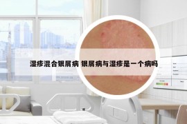 湿疹混合银屑病 银屑病与湿疹是一个病吗