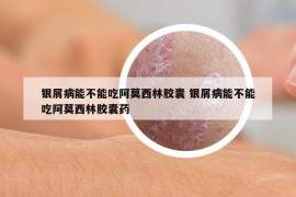 银屑病能不能吃阿莫西林胶囊 银屑病能不能吃阿莫西林胶囊药