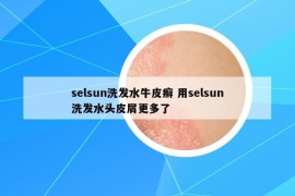 selsun洗发水牛皮癣 用selsun洗发水头皮屑更多了