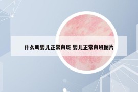 什么叫婴儿正常白斑 婴儿正常白班图片