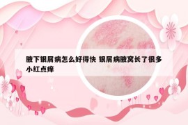 腋下银屑病怎么好得快 银屑病腋窝长了很多小红点痒