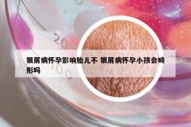 银屑病怀孕影响胎儿不 银屑病怀孕小孩会畸形吗