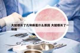 大腿根长了几块癣是什么原因 大腿根长了一块癣