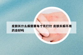 皮肤长什么癣需要每个月打针 皮肤长癣不用药会好吗