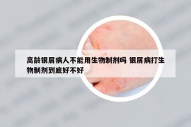 高龄银屑病人不能用生物制剂吗 银屑病打生物制剂到底好不好