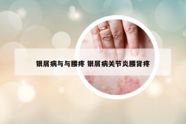 银屑病与与腰疼 银屑病关节炎腰背疼