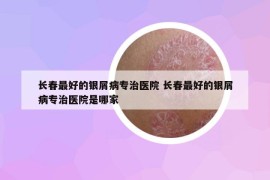 长春最好的银屑病专治医院 长春最好的银屑病专治医院是哪家