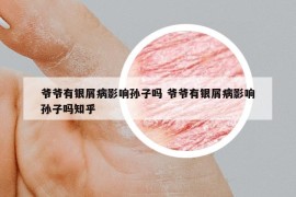 爷爷有银屑病影响孙子吗 爷爷有银屑病影响孙子吗知乎