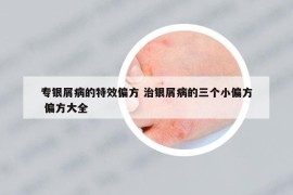 专银屑病的特效偏方 治银屑病的三个小偏方 偏方大全