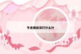 牛皮癣应该打什么针