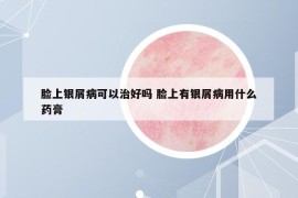 脸上银屑病可以治好吗 脸上有银屑病用什么药膏