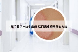 肛门长了一块牛皮癣 肛门表皮癣用什么方法