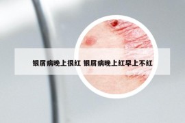 银屑病晚上很红 银屑病晚上红早上不红