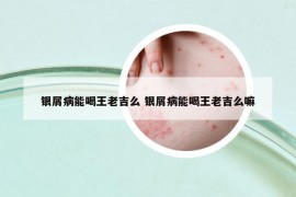 银屑病能喝王老吉么 银屑病能喝王老吉么嘛