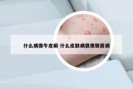 什么病像牛皮癣 什么皮肤病很像银屑病