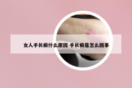 女人手长癣什么原因 手长癣是怎么回事