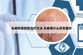 头癣的症状和治疗方法 头癣用什么药膏最好