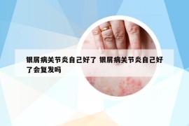 银屑病关节炎自己好了 银屑病关节炎自己好了会复发吗