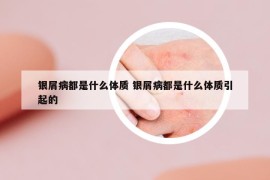 银屑病都是什么体质 银屑病都是什么体质引起的