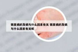 银屑病的发病与什么因素有关 银屑病的发病与什么因素有关呢