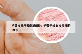 手臂皮肤干燥起癣图片 手臂干燥有皮屑图片 红斑