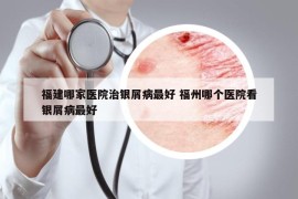 福建哪家医院治银屑病最好 福州哪个医院看银屑病最好