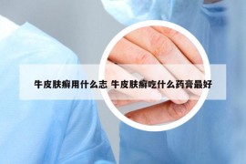 牛皮肤癣用什么志 牛皮肤癣吃什么药膏最好