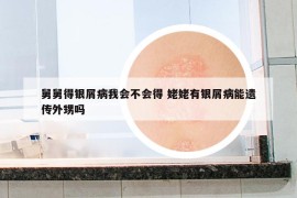 舅舅得银屑病我会不会得 姥姥有银屑病能遗传外甥吗