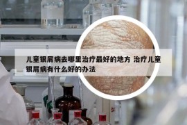 儿童银屑病去哪里治疗最好的地方 治疗儿童银屑病有什么好的办法