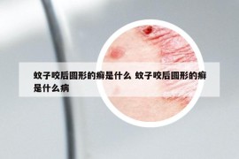 蚊子咬后圆形的癣是什么 蚊子咬后圆形的癣是什么病