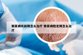 银屑病巩固期怎么治疗 银屑病稳定期怎么治疗